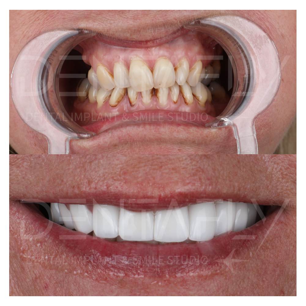 Dental Implant Photos done in Turkey