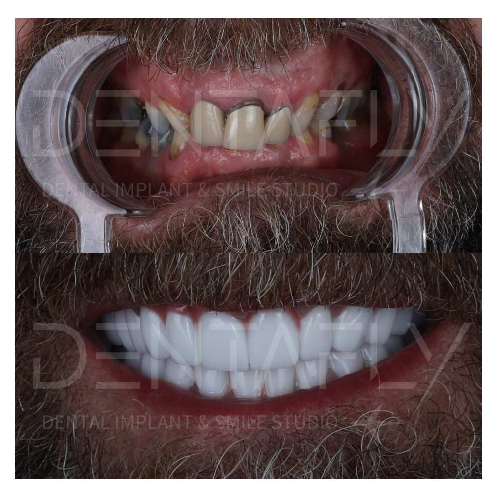 Dental Implant before after view in Turkey