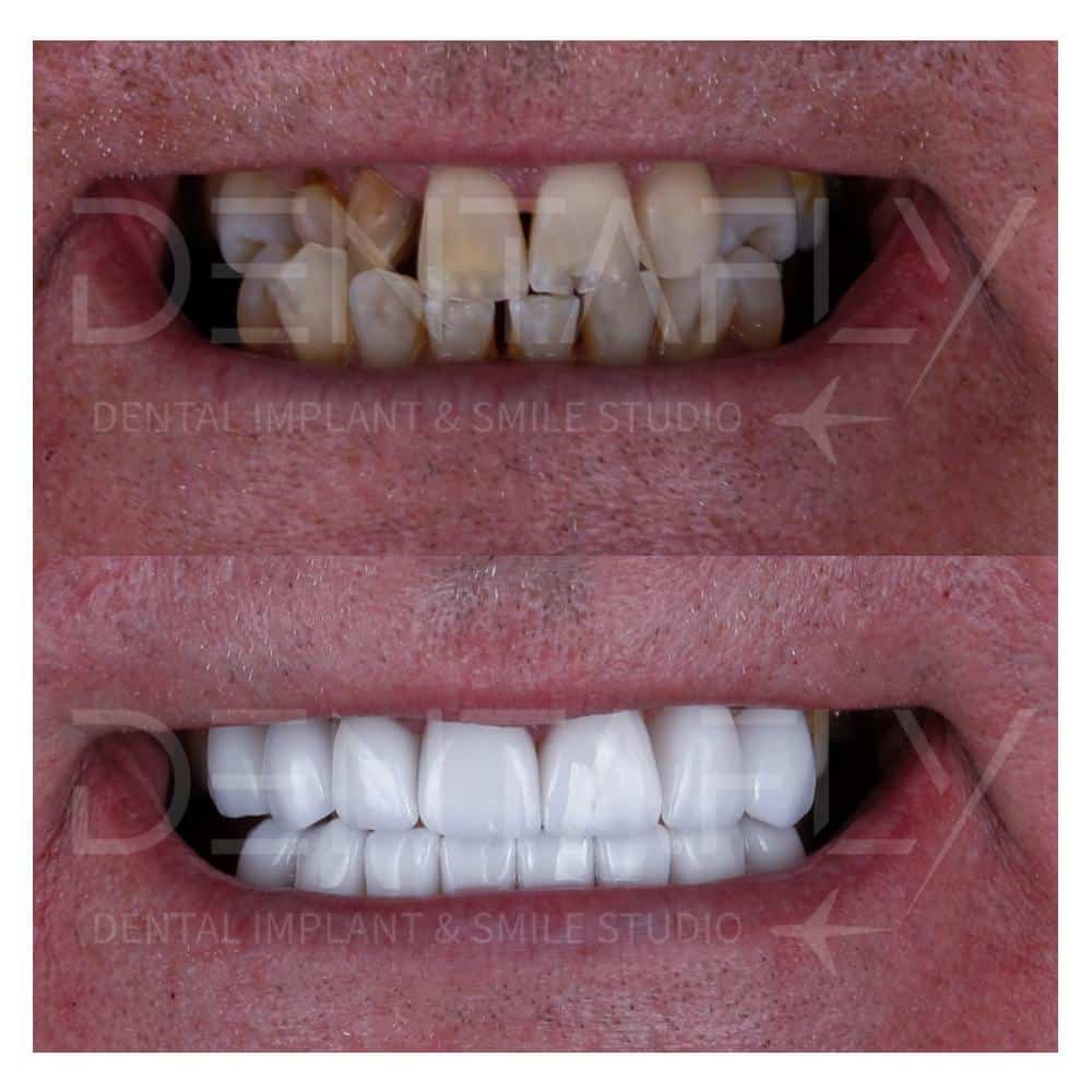 Dental Implant in Turkey before After Photos