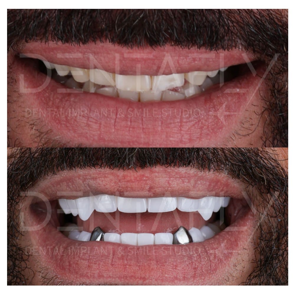 smile-design-before-after-13