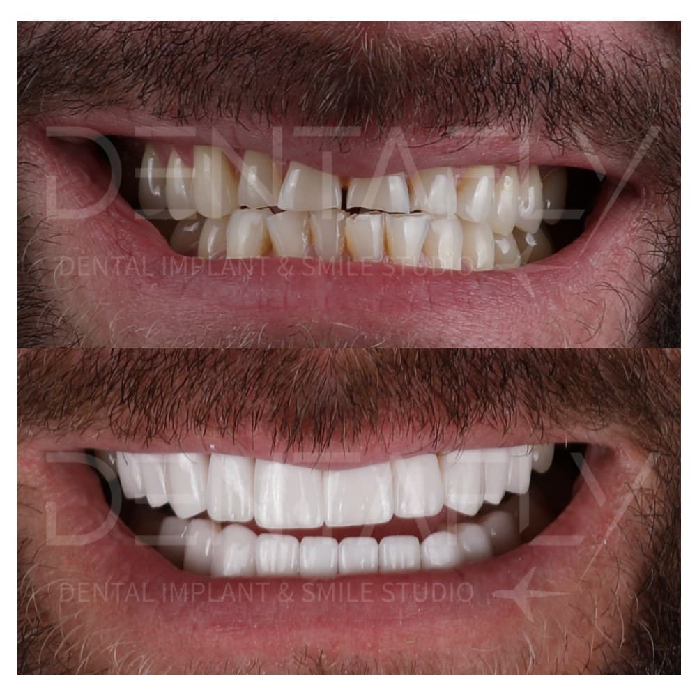 smile-design-before-after-14