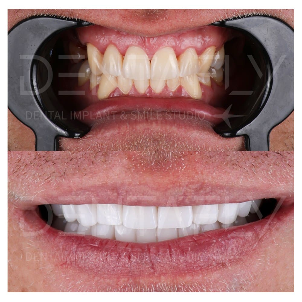 smile-design-before-after-16