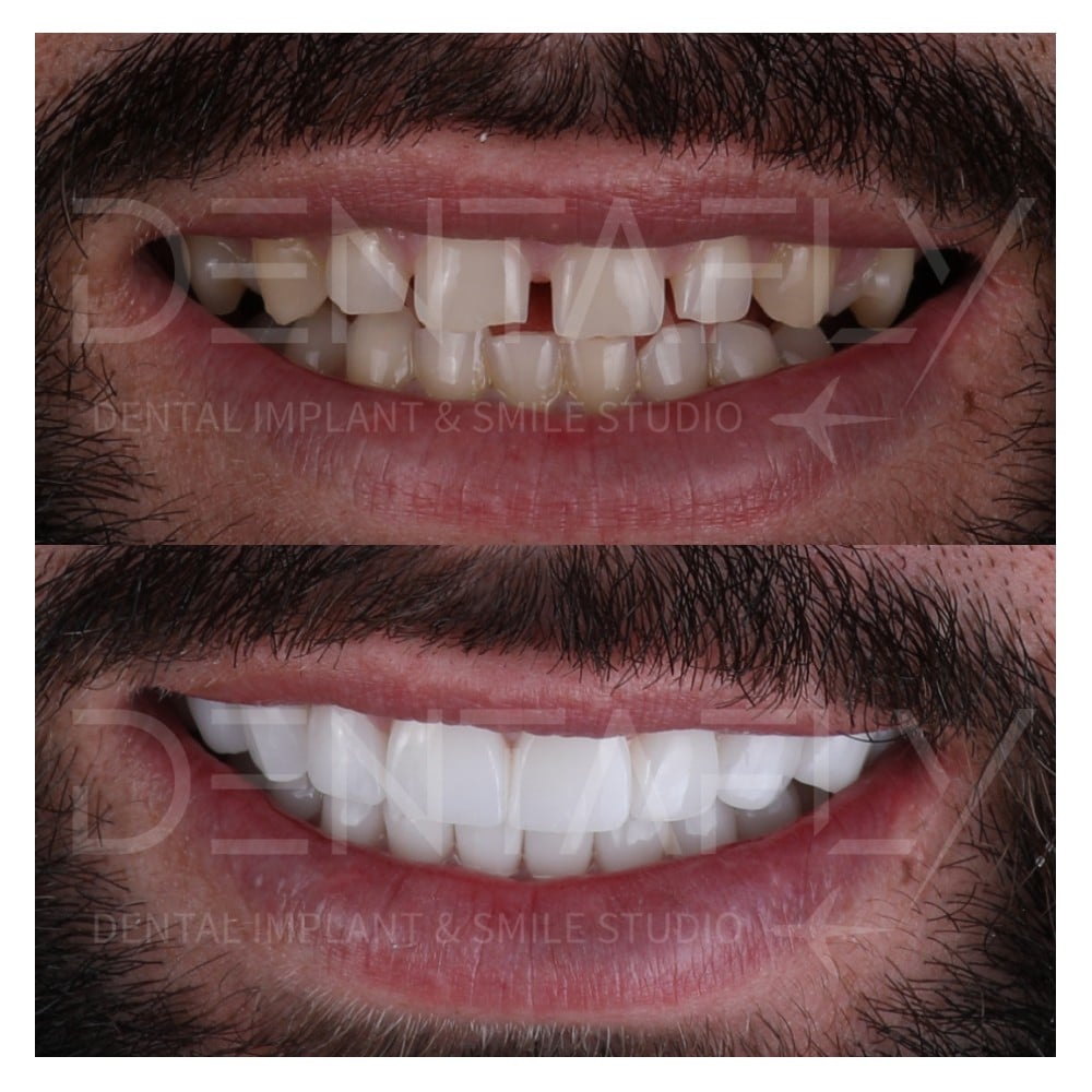 smile-design-before-after-18
