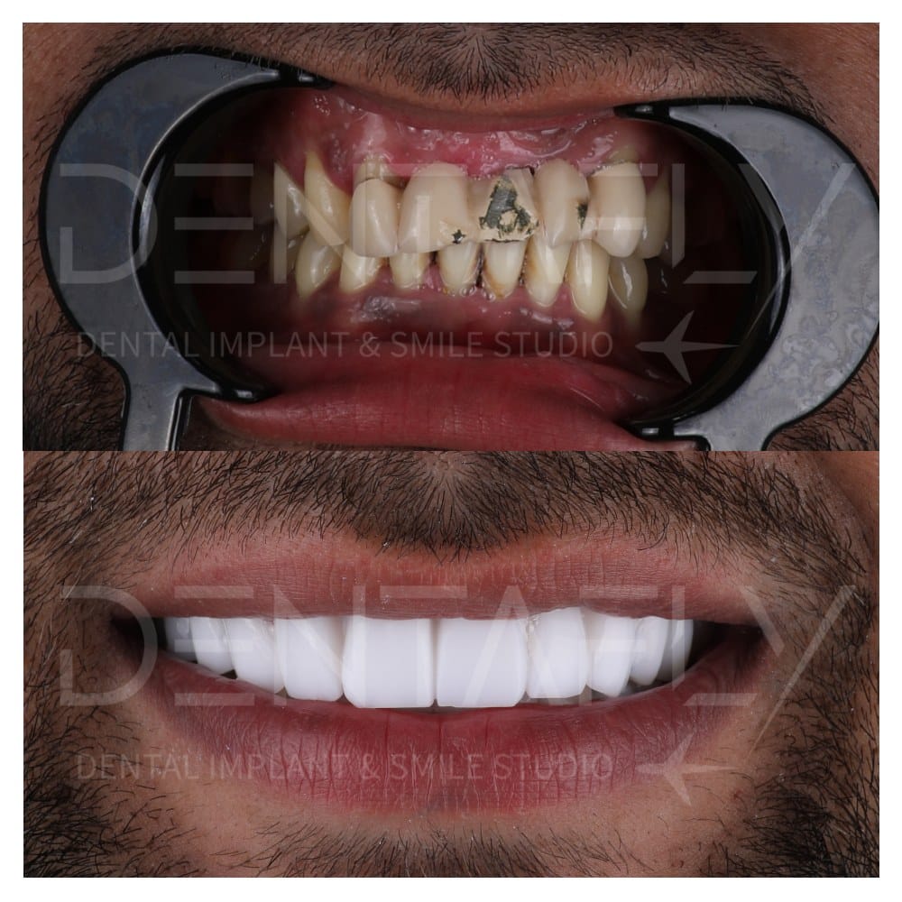 smile-design-before-after-20