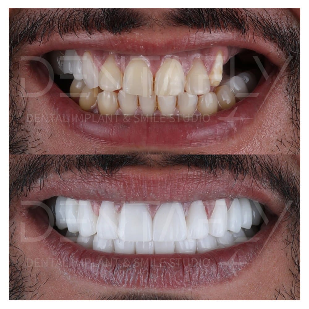 smile-design-before-after-22