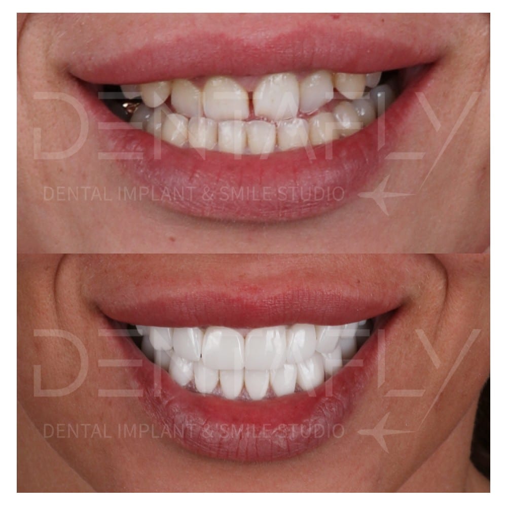 smile-design-before-after-24