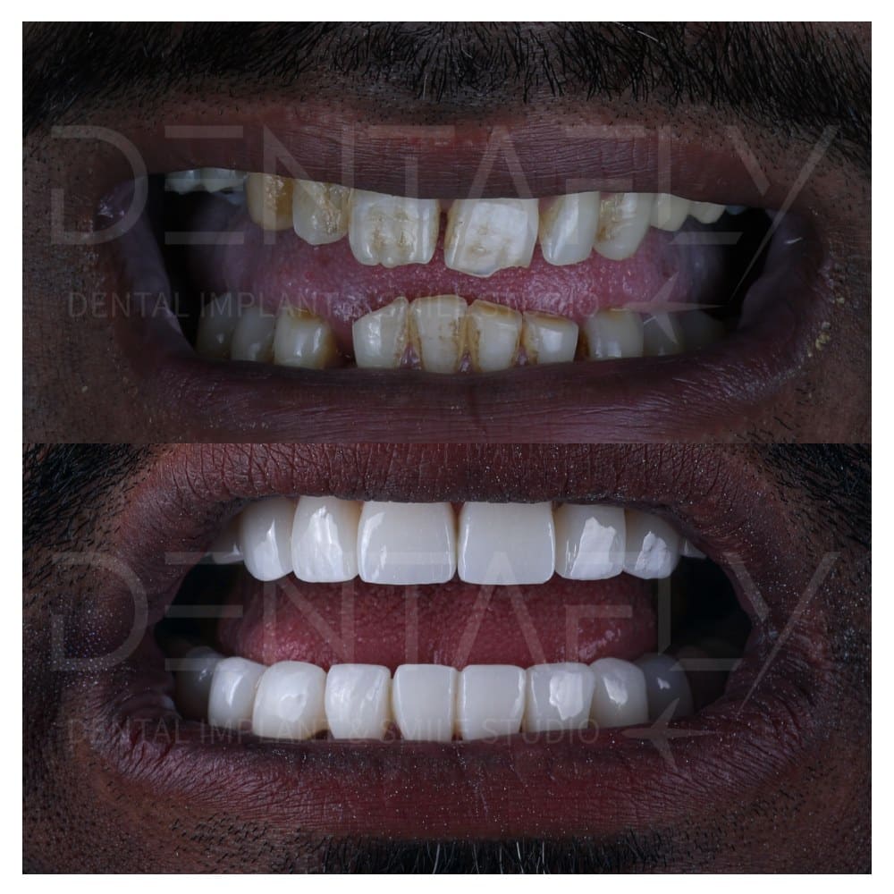 smile-design-before-after-8