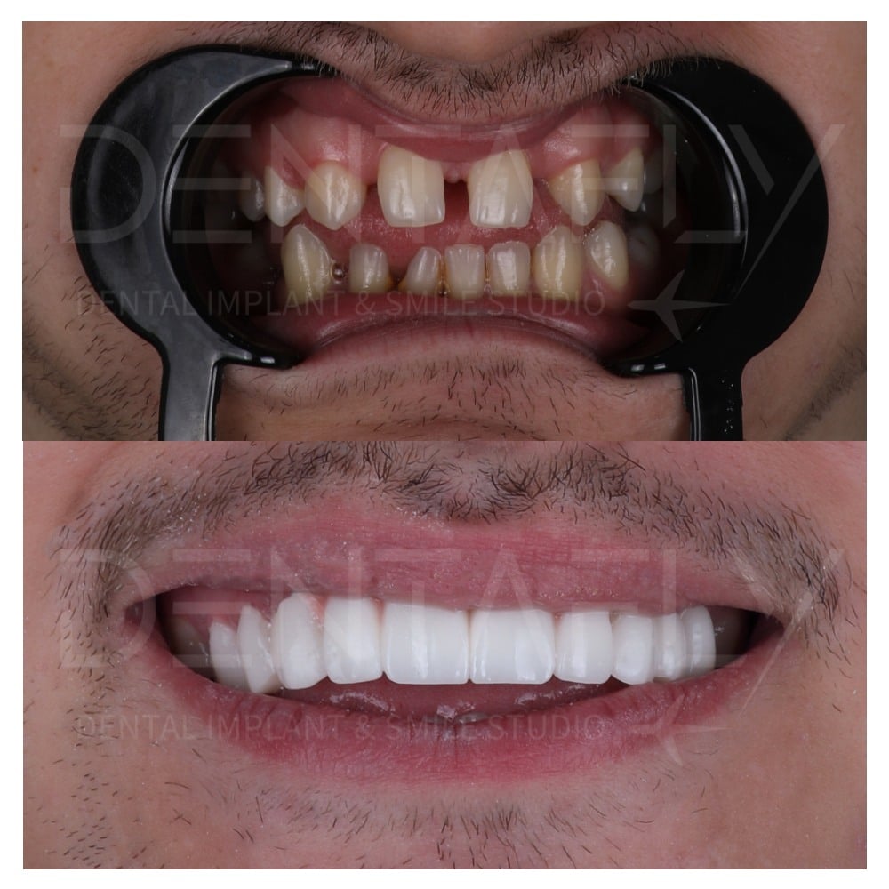 smile-design-before-after-9