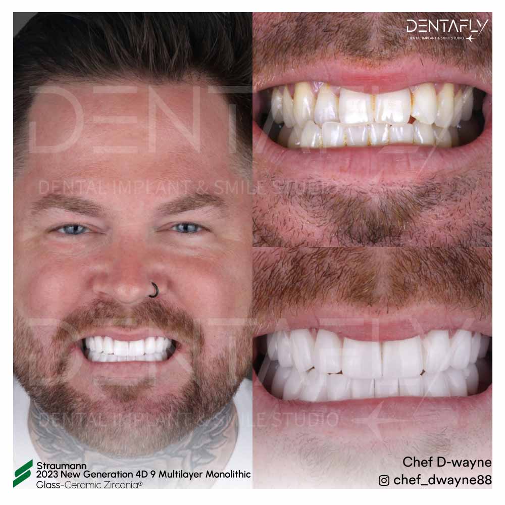 Chef D Wayne Before After Teeth