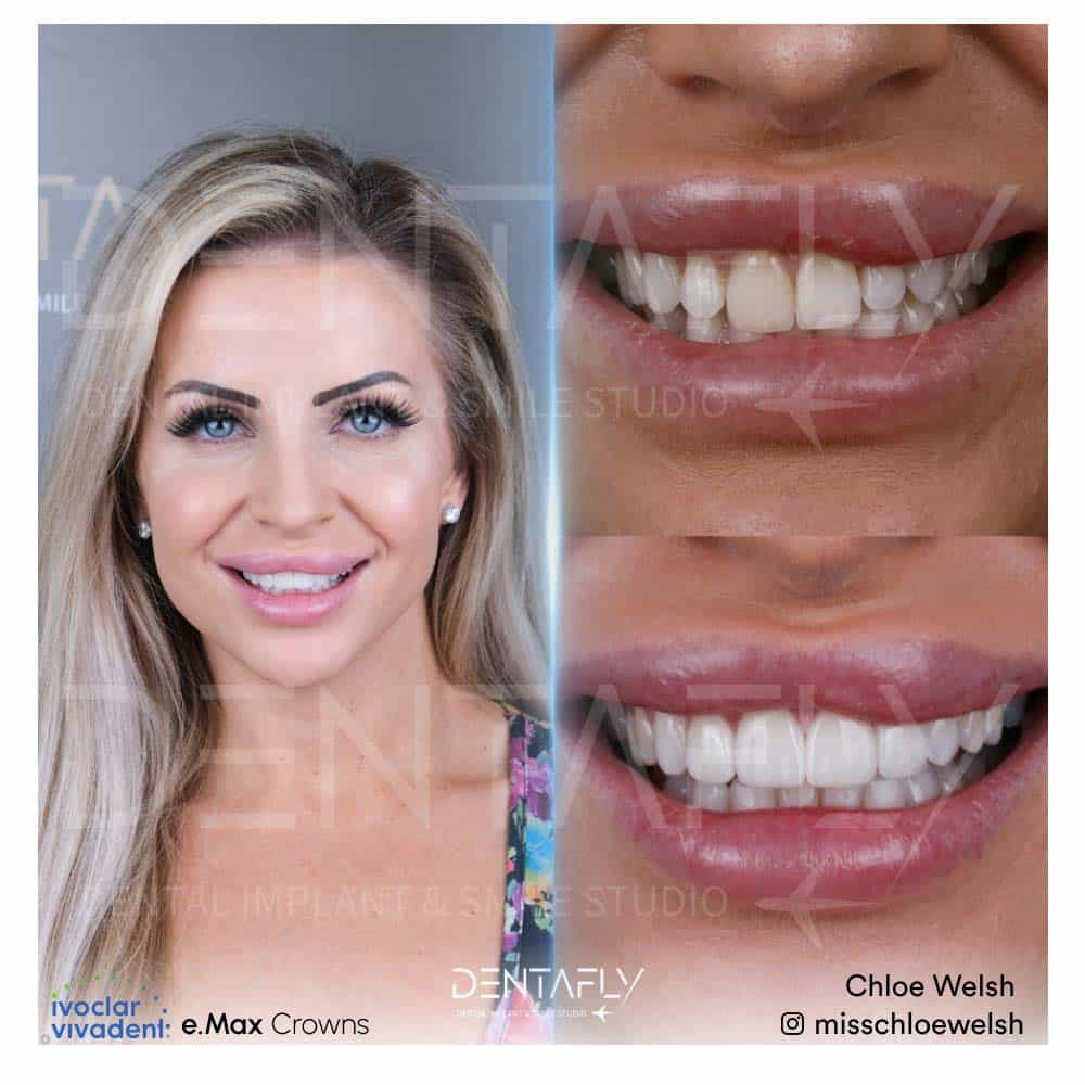Chloe Welsh - Before and After