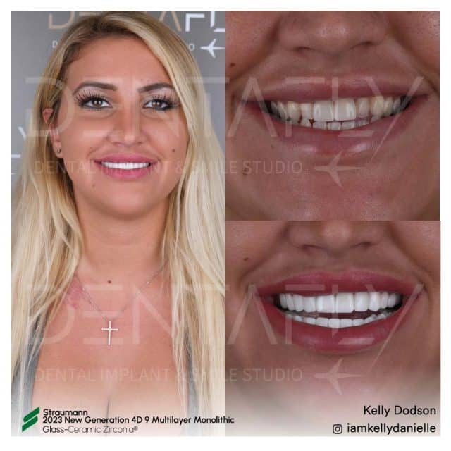 Kelly Dodson - Before and after teeth in Turkey