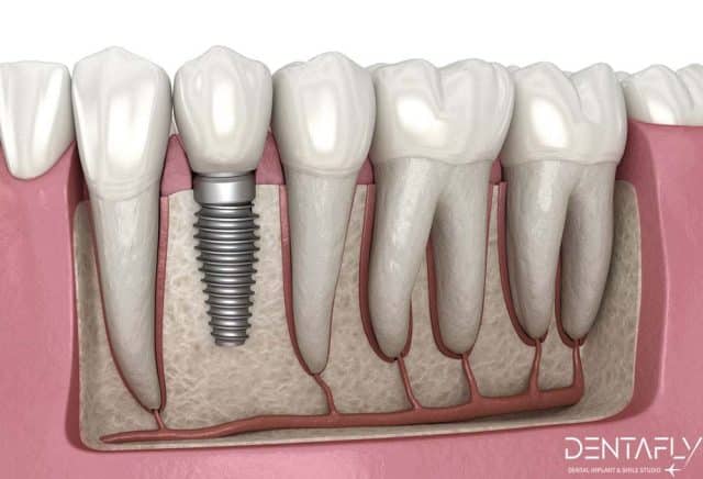 dental implant simulation view