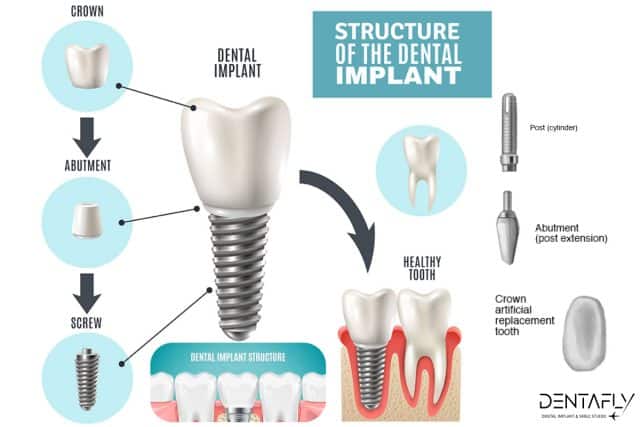 how do dental implants work?