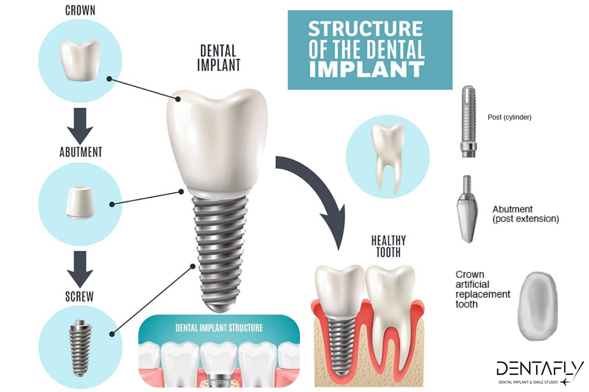 Dental Implants in Turkey Costs, Procedures, Abroad