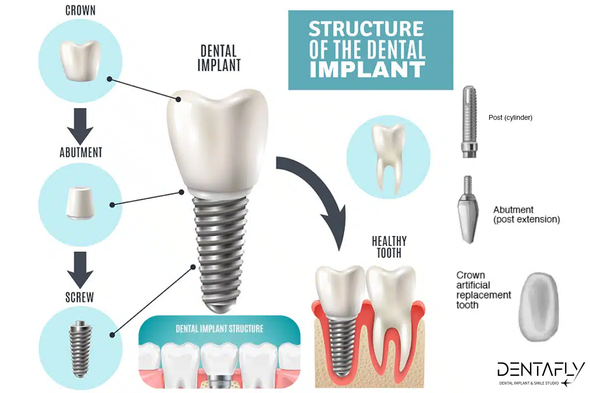 Dental Implant Costs in Turkey + £500 Same Day