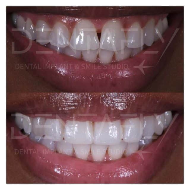 composite bonding before after