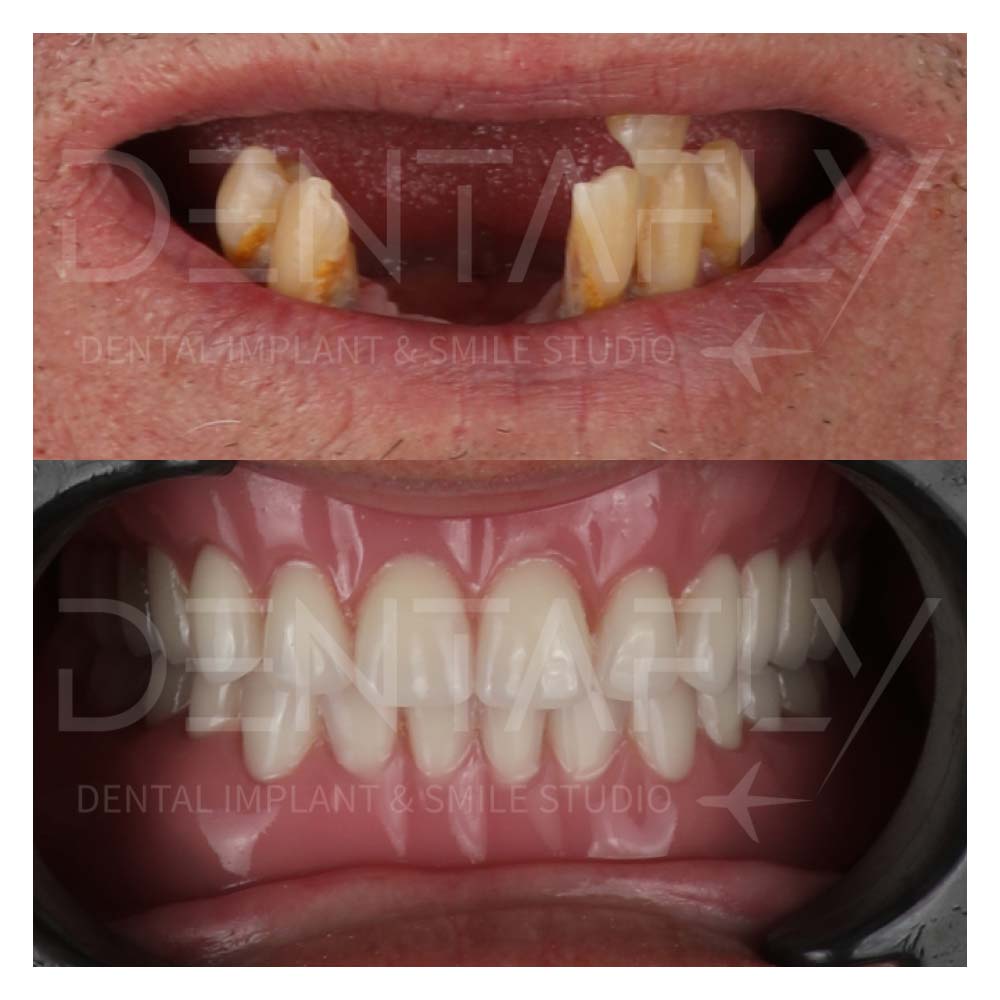 dental implant before after photo in April