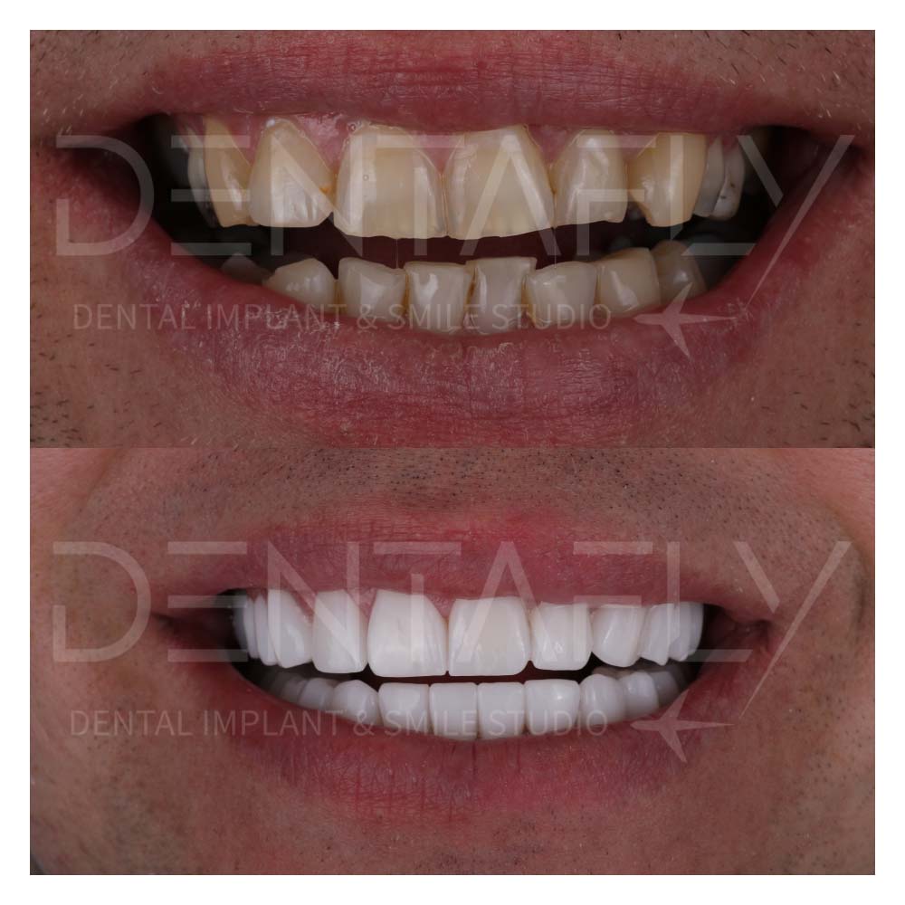 dental-implants-before-after-2-April