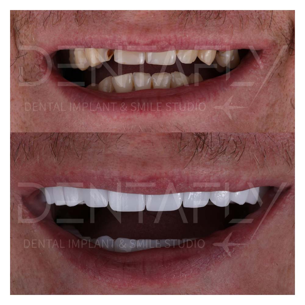 dental implants before after photo from April 2024