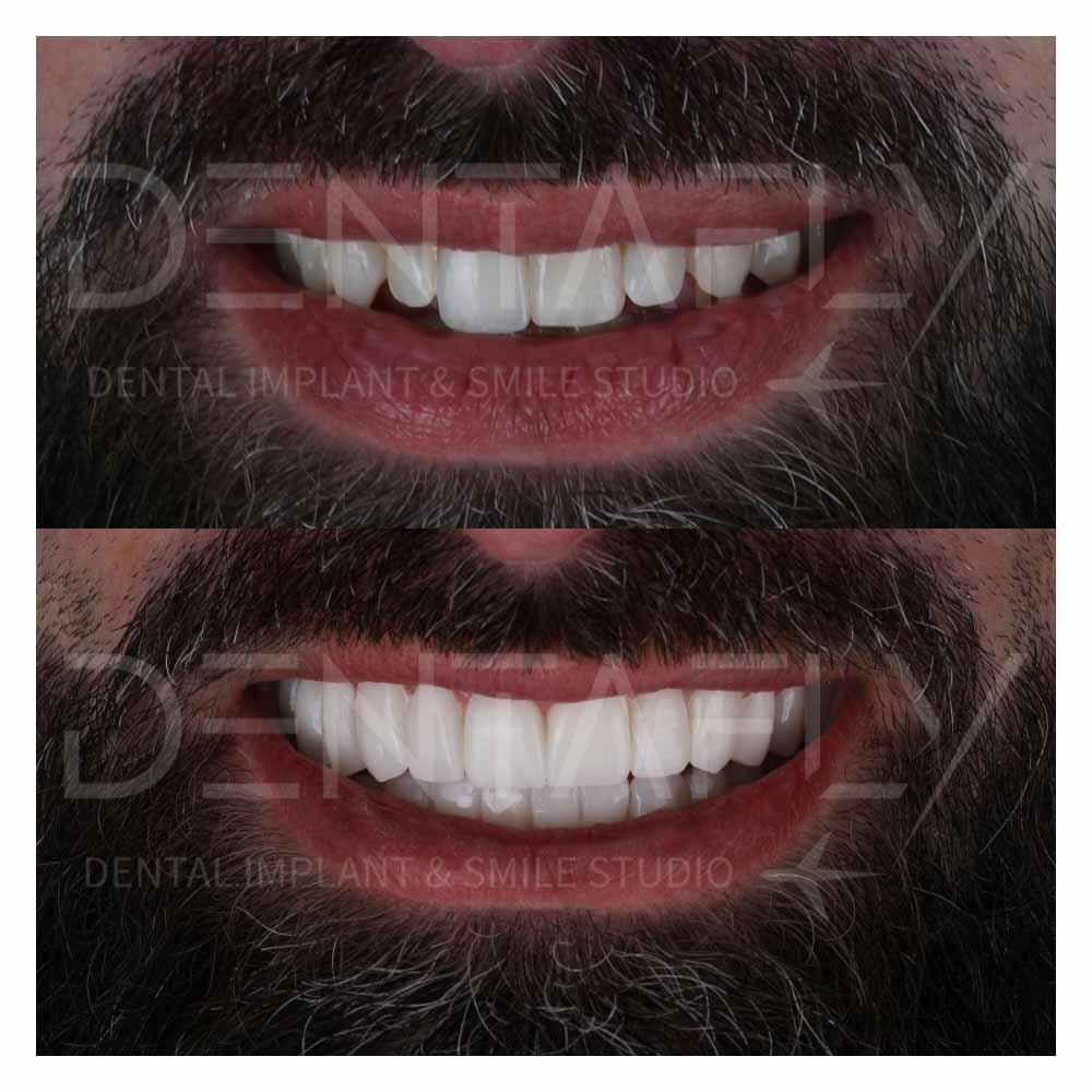 smile design before after treatment