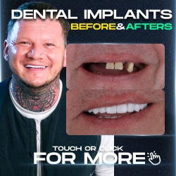 Dental Implant Before After gallery