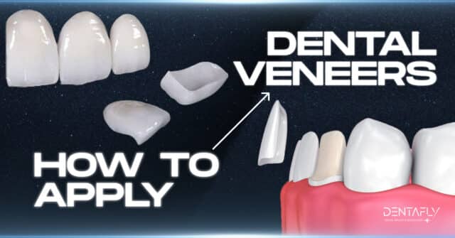 how to apply dental veneers