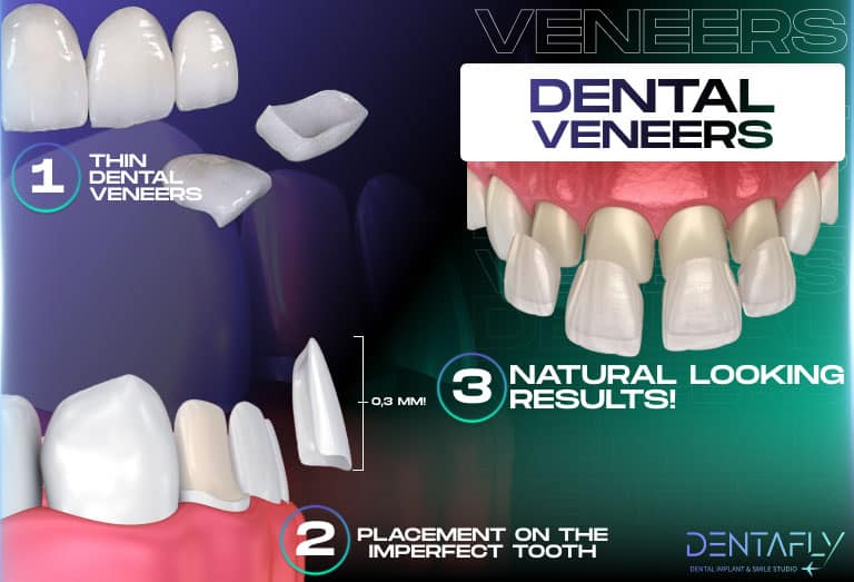 Dental Veneers stages