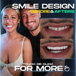 Smile Design before after
