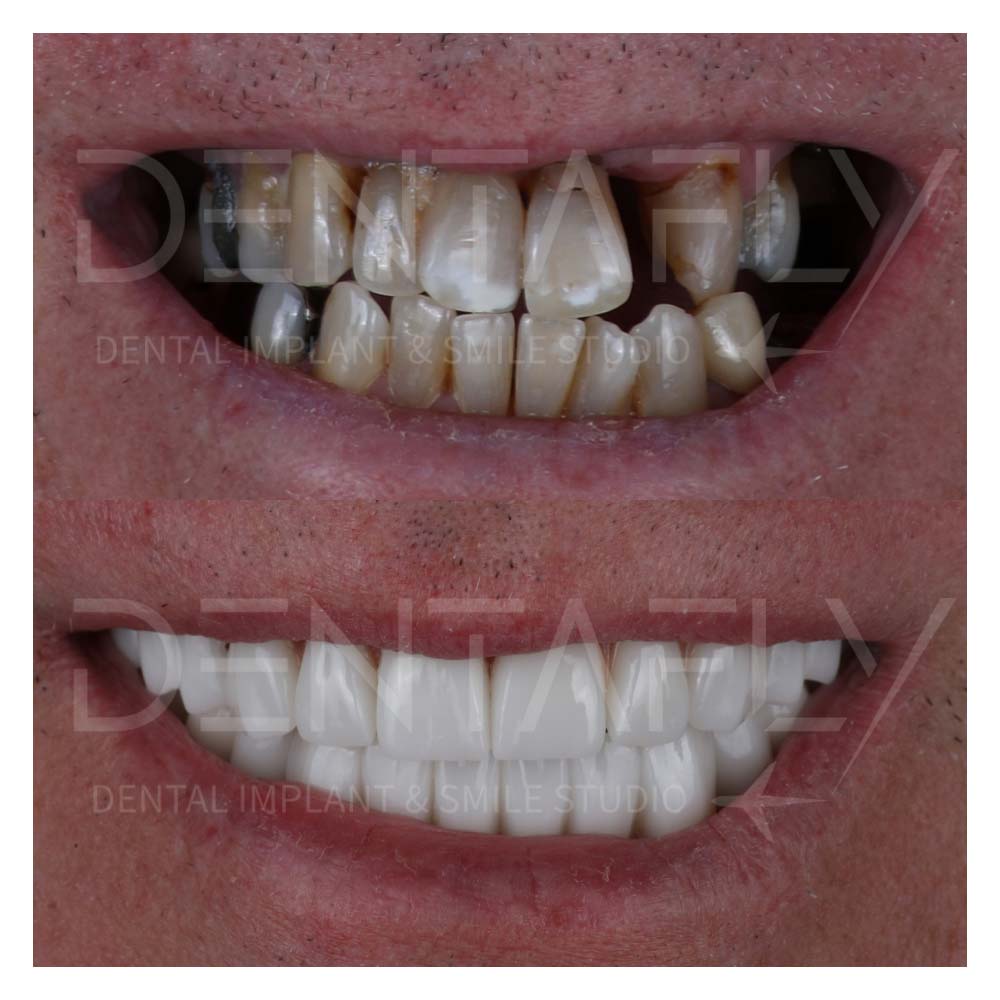 zirconium crowns before after-21may-1