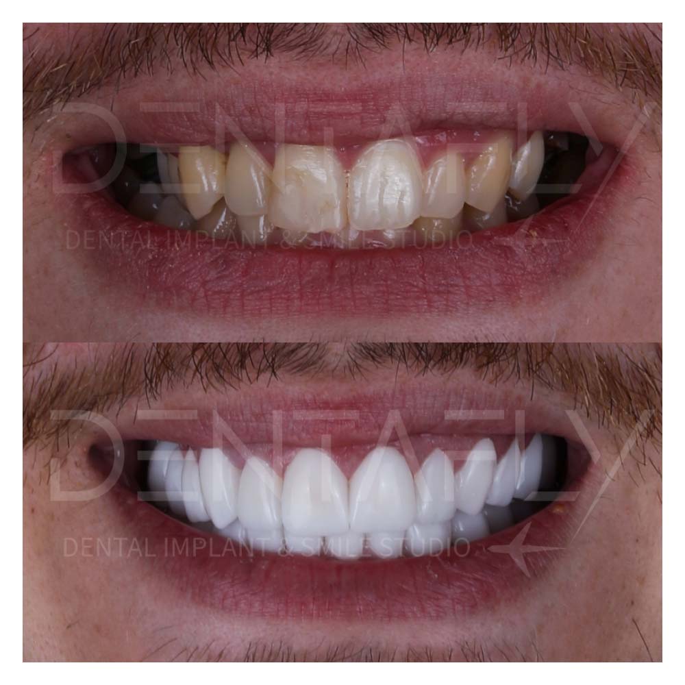 zirconium-crowns-before-after-21may-10