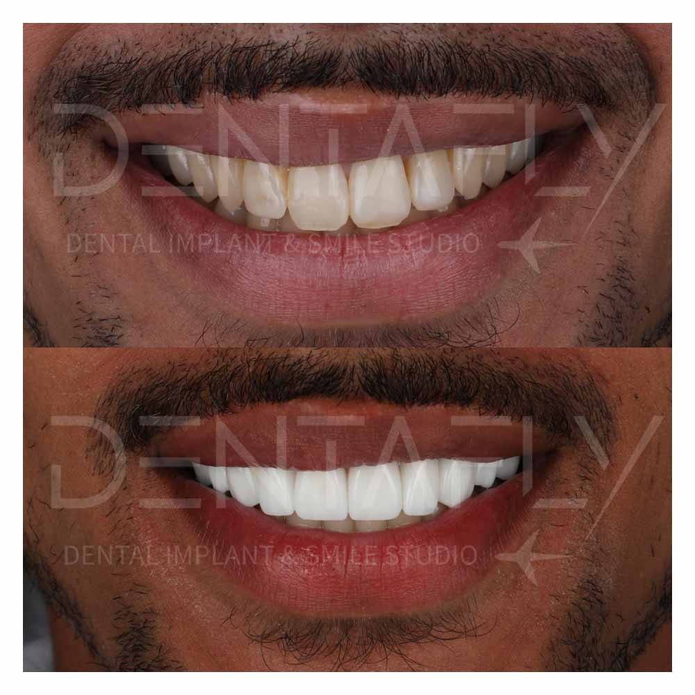 zirconium-crowns-before-after-21may-11