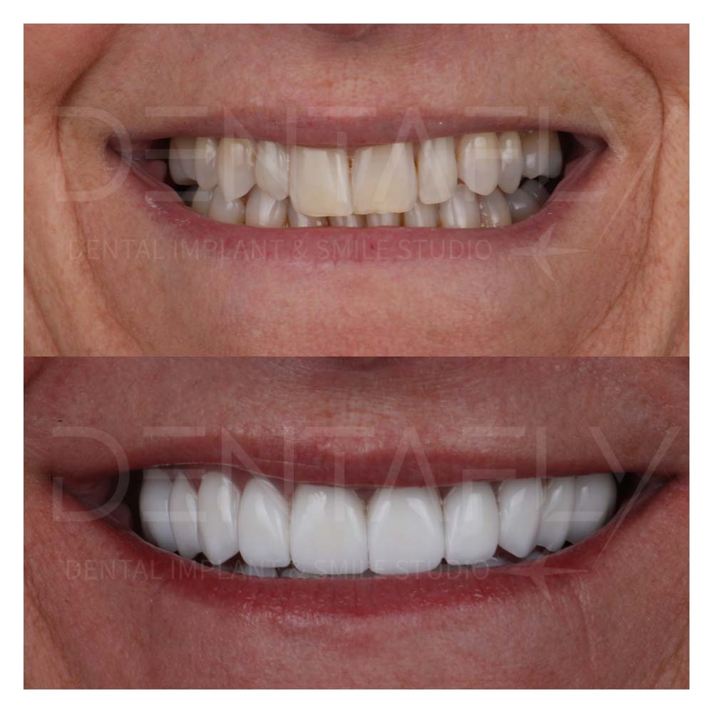 zirconium-crowns-before-after-21may-12