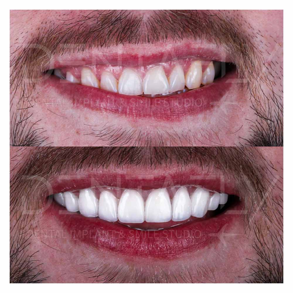 zirconium-crowns-before-after-21may-13