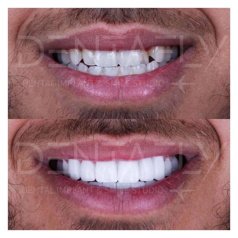 zirconium-crowns-before-after-21may-14