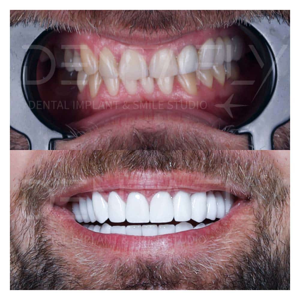 zirconium-crowns-before-after-21may-15