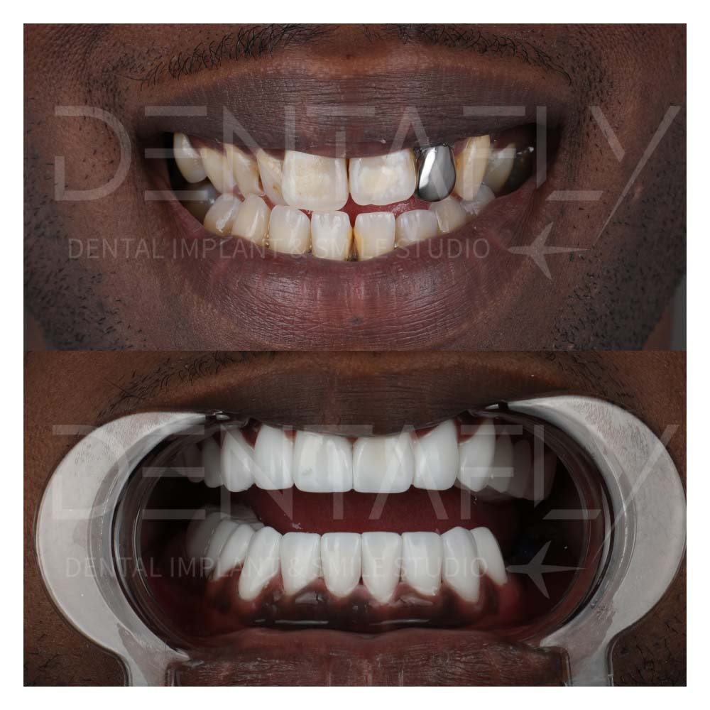 zirconium-crowns-before-after-21may-6