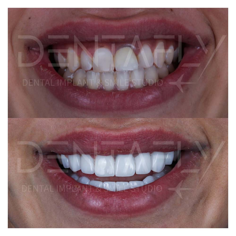 zirconium-crowns-before-after-21may-7