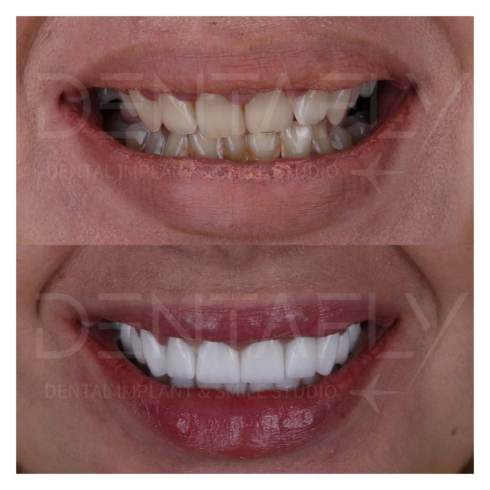 zirconium-crowns-before-after-21may-8