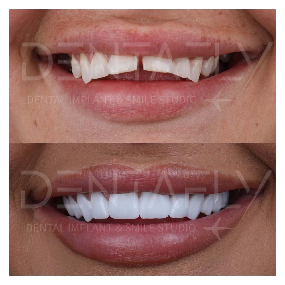 zirconium-crowns-before-after-21may-9