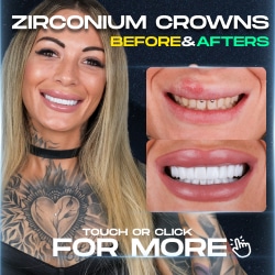 Zirconium Crowns Before After