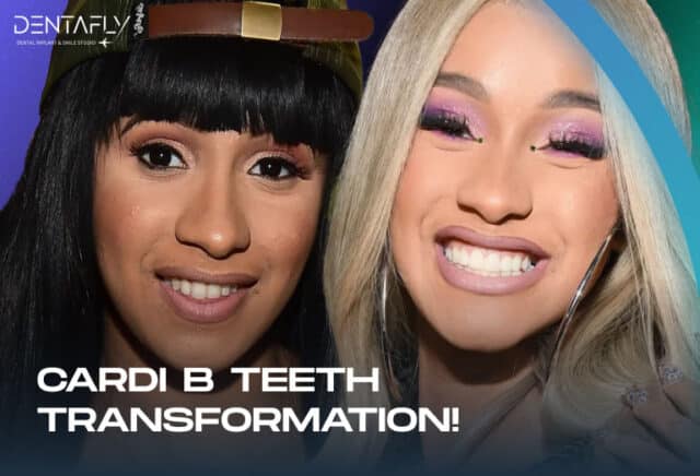 Cardi B. Transformation of Teeth