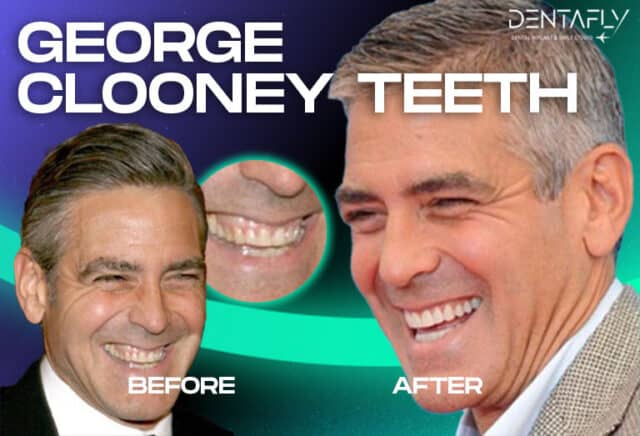 George Clooney Teeth Before After