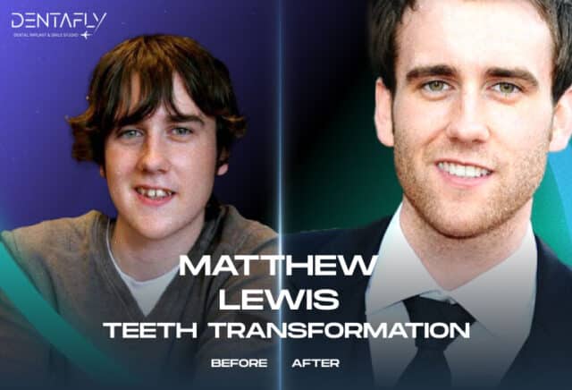 Matthew Lewis Teeth transformation