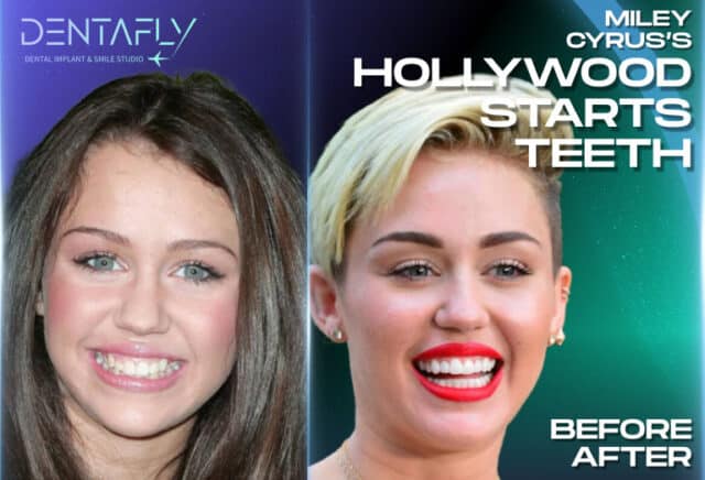 Miley Cyrus done her teeth when started Hollywood career