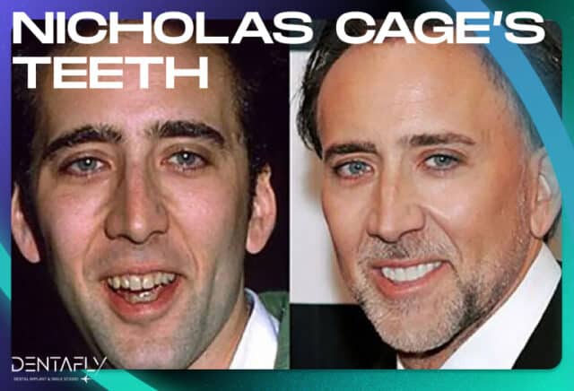 Nicholas Cage's Teeth