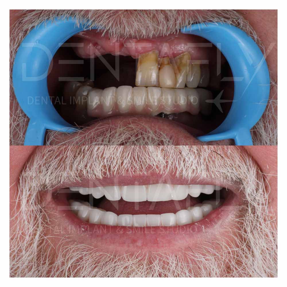 turkey-teeth-before-after-gallery-1