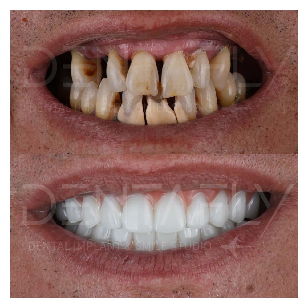 turkey-teeth-before-after-gallery-10