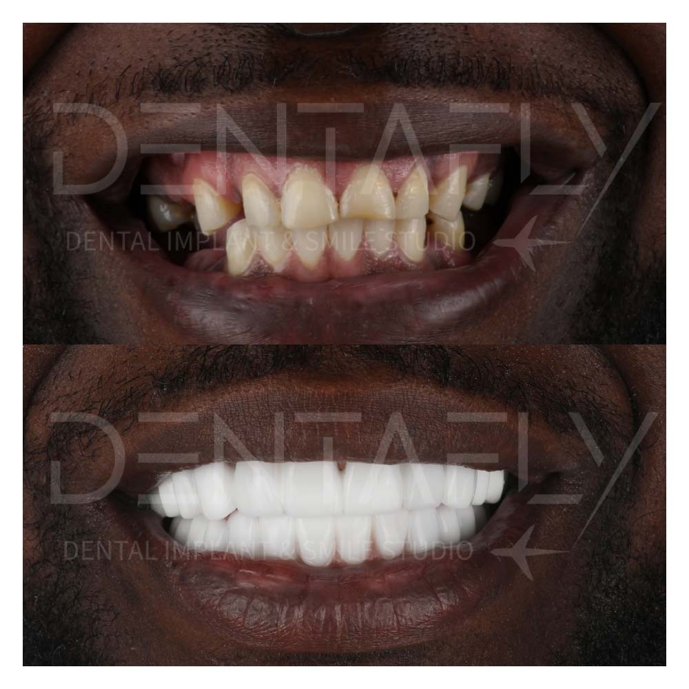 turkey-teeth-before-after-gallery-2