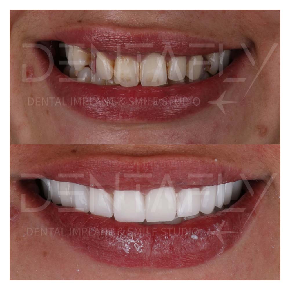 turkey-teeth-before-after-gallery-3