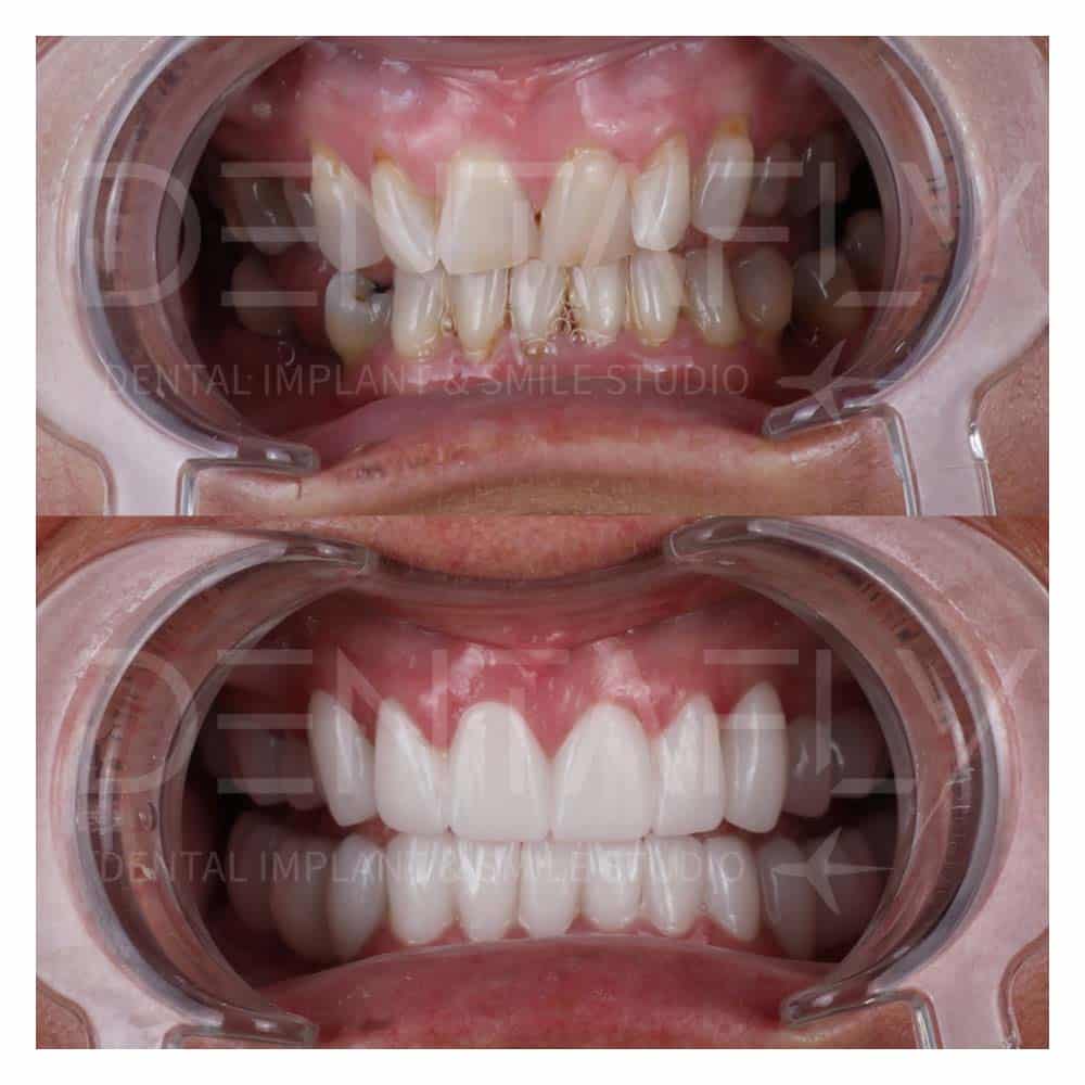 turkey-teeth-before-after-gallery-4